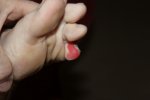 small blister 2.JPG